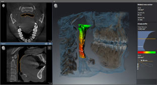 Sirona Orthophos SL 3D (11x10) – Дентальный томограф